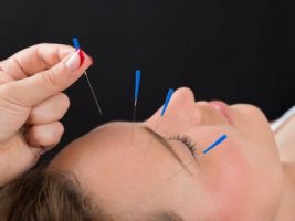 Medical acupuncture treatment for pain relief at Four Oaks Physio Sutton Coldfield